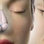 Rhinoplasty Surgery Cost In India