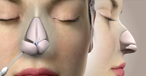 Rhinoplasty Surgery