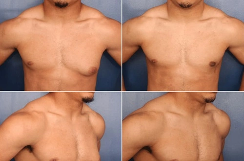 Gynecomastia Surgery