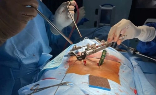 Spine Surgery