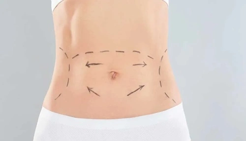 Tummy Tuck