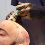 Hair Transplant in Riyadh