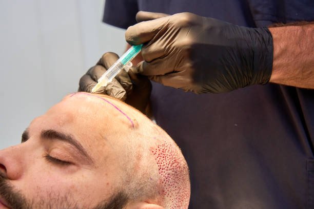 Hair Transplant in Riyadh