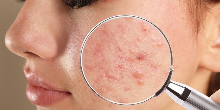 Acne Treatment in Riyadh