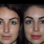 Septoplasty in Dubai