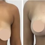 breast reduction in Dubai