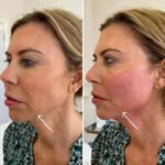 Best Aesthetic Clinics in Dubai Explain Endolift for Jawline Definition