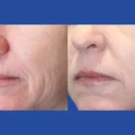 fractional-rf-microneedling