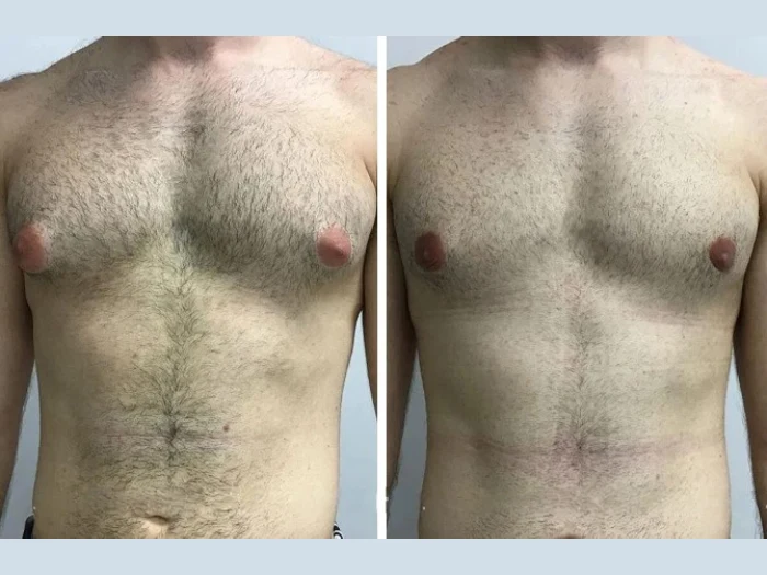 How to Choose the Best Gynecomastia Surgeons in Dubai for Your Body Type Gynecomastia in Dubai