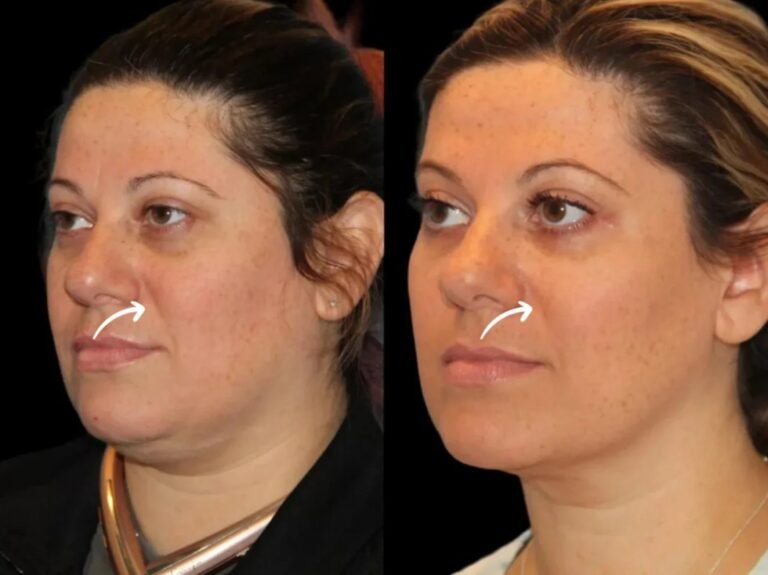 Best Plastic Surgeons in Dubai Recommend Sculptra for Chin Lines sculptra in dubai
