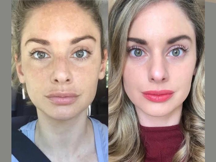 Exclusive RF Microneedling Experiences with the Best Doctors in Dubai Radiofrequency (RF) Microneedling in Dubai