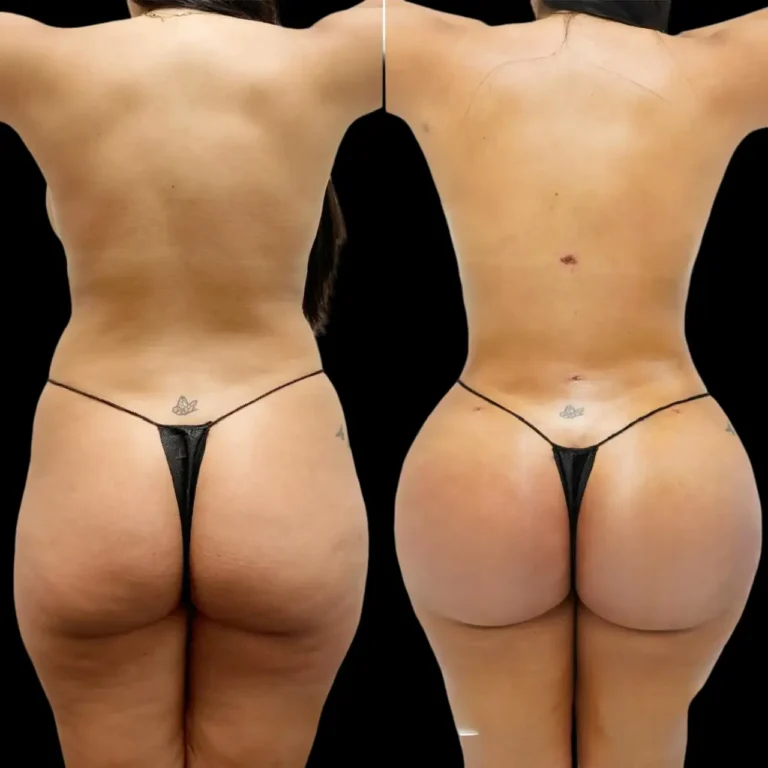 Best Doctors in Dubai for Butt Fat Transfer Designed to Improve Shape, Volume, and Symmetry Fat transfer in dubai