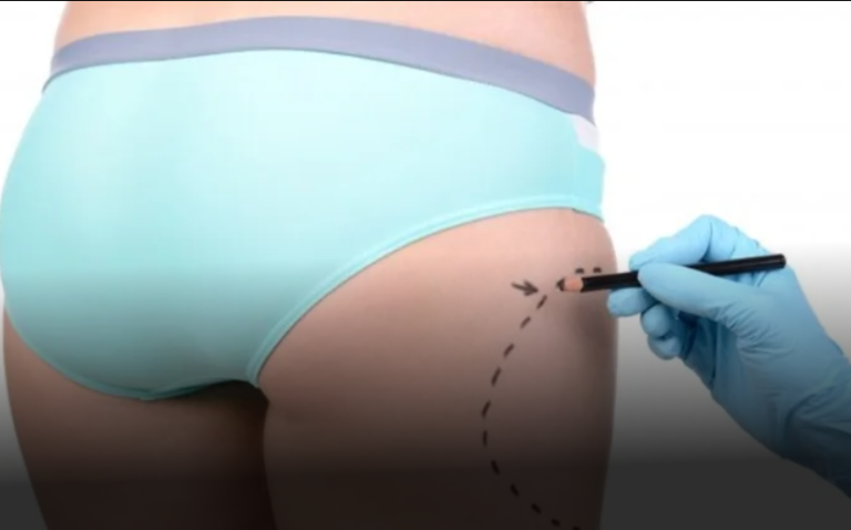 Buttocks Liposuction in Dubai – Safe and Reliable Techniques