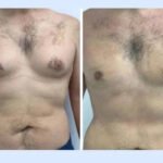 gynecomastia in dubai.