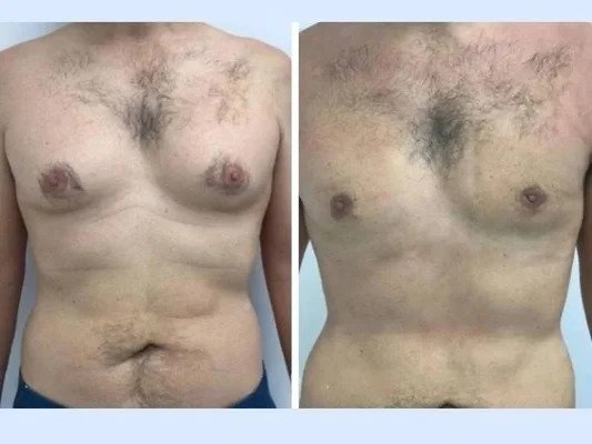 Best Gynecomastia Surgeon in Dubai: How Surgeons Support Patients Throughout Recovery gynecomastia in dubai.