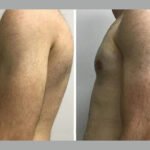 Gynecomastia Surgery in Dubai