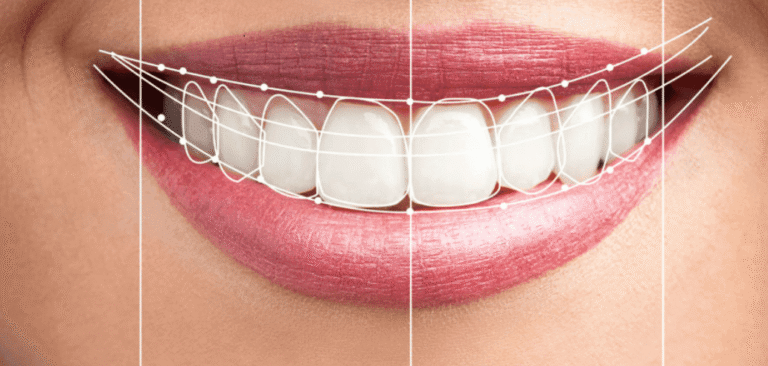 Hollywood Smile in Dubai – Get a Celebrity-Style Transformation Hollywood Smile in Dubai