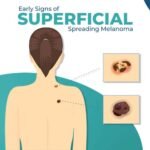 superficial melanoma