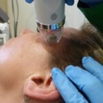5 Reasons Why Microneedling Is Ruling Chicago Spas