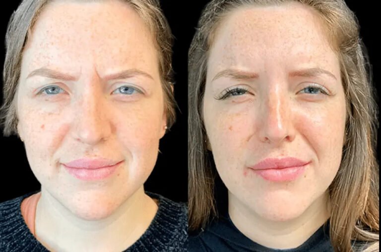 Celebrity-inspired Endolift transformations at Best Aesthetic Clinics in dubai