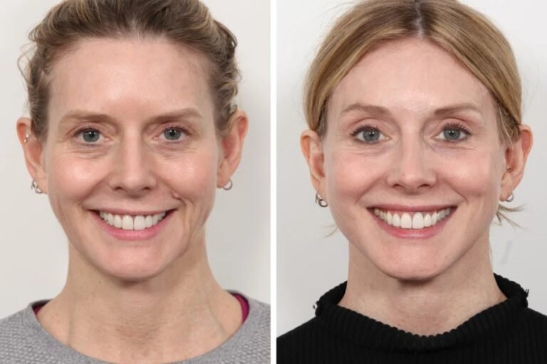 Best Aesthetic Clinic in Dubai for Subtle Anti-Aging Treatments Thread lift in Dubai