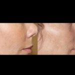 Fractional RF Microneedling in Dubai