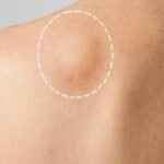 lipoma treatment in Islamabad