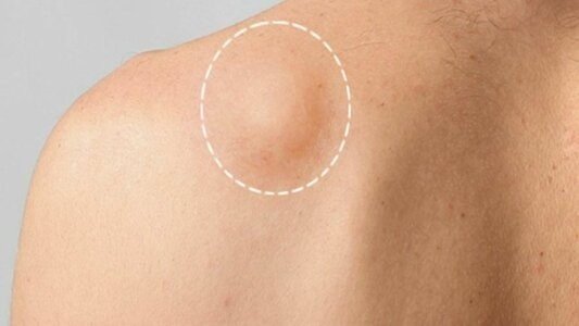 Trusted Lipoma treatment in Islamabad – Confidence Back lipoma treatment in Islamabad