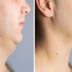 chin lipo treatment