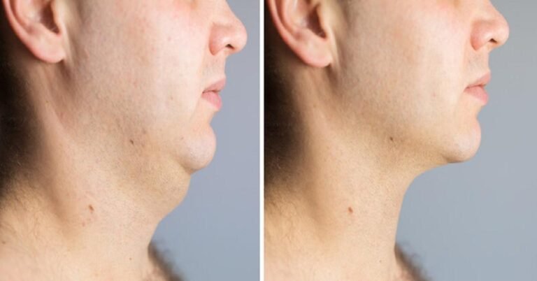 chin lipo treatment