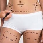 liposuction in islamabad