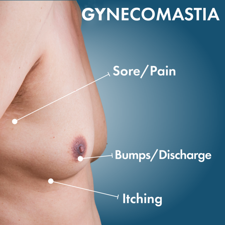 Best Clinics for Gynecomastia in Islamabad: How to Choose the Right Surgeon gynecomastia in islamabad