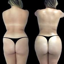 Butt Fat transfer surgery in dubai for Natural Feel Results butt fat transfer in dubai