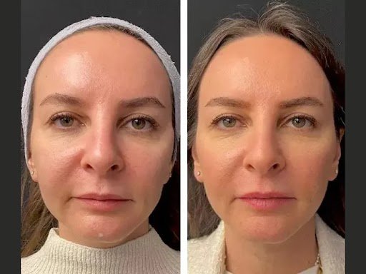 Mesotherapy Treatments in Dubai: Latest Trends in Aesthetic Treatments