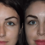 rhinoplasty in dubai