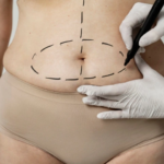 Liposuction