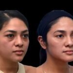 Dark Circles Treatment in Dubai