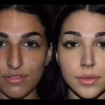 Rhinoplasty in Dubai