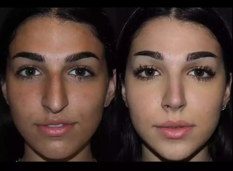 Rhinoplasty in Dubai