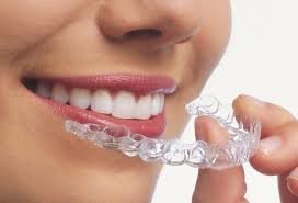 Why Aligners In Dubai Are the Modern Alternative to Braces