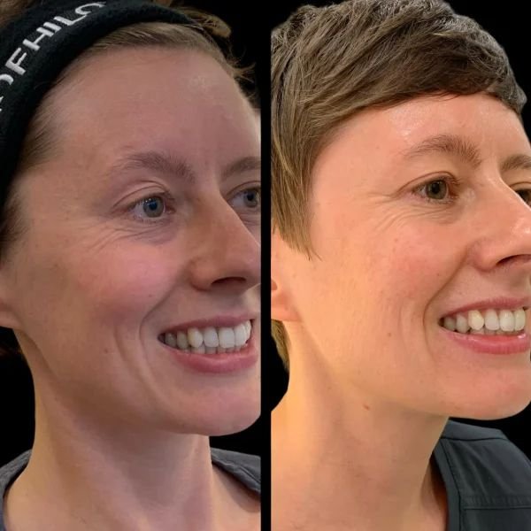 Profhilo Glow with the Best Plastic Surgeon in Dubai Profhilo in Dubai