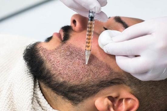 مستقبل زراعة الشعر: كيف غيرت تقنيات دبي الحديثة شكل اللحية؟ زراعة شعر اللحية في دبي