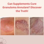 Can Supplements Cure Granuloma Annulare