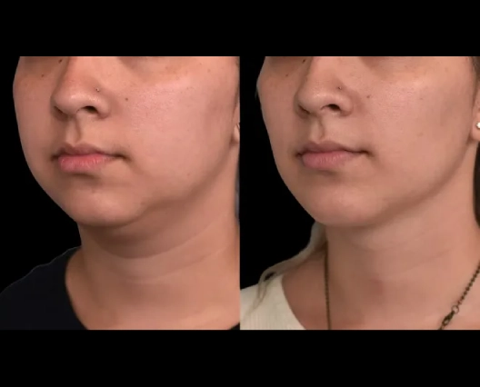 Recovery Timeline After Double chin removal in Dubai Double chin removal in Dubai