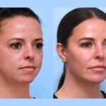 Thread Lift with Best Plastic Surgeons in Dubai Customized Treatment Plans