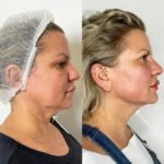 Best Doctors in dubai for Quick Recovery Endolift Procedures