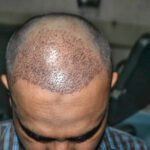 زراعة الشعر في دبي