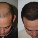 تكلفة زراعة الشعر في دبي
