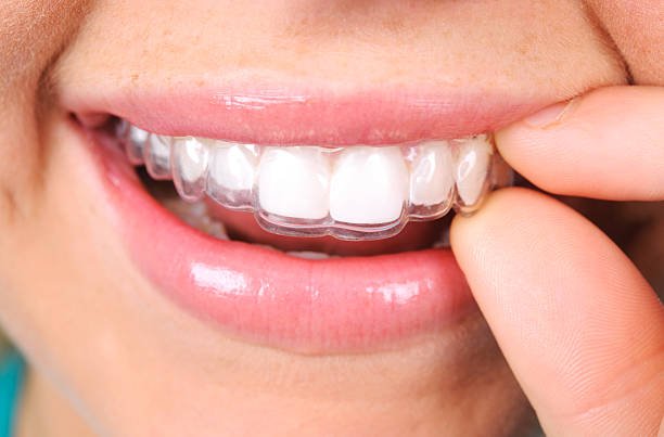 Straighten Your Smile Comfortably with Modern Invisalign Solutions in Wilton