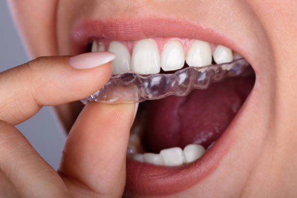 Invisalign Dana Point: Get The Confident Smile You Deserve.